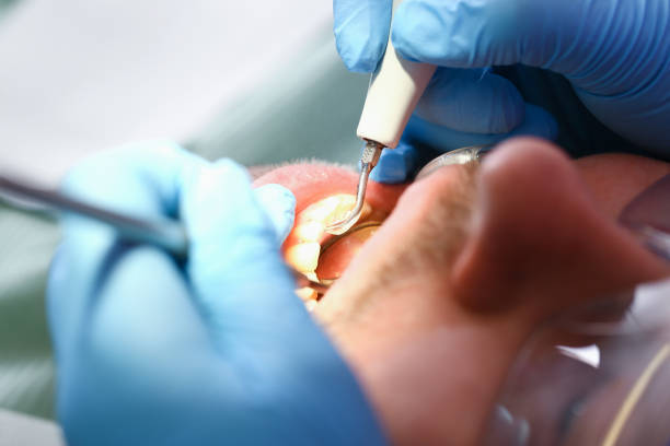 Best Emergency Root Canal Treatment in Elton, LA