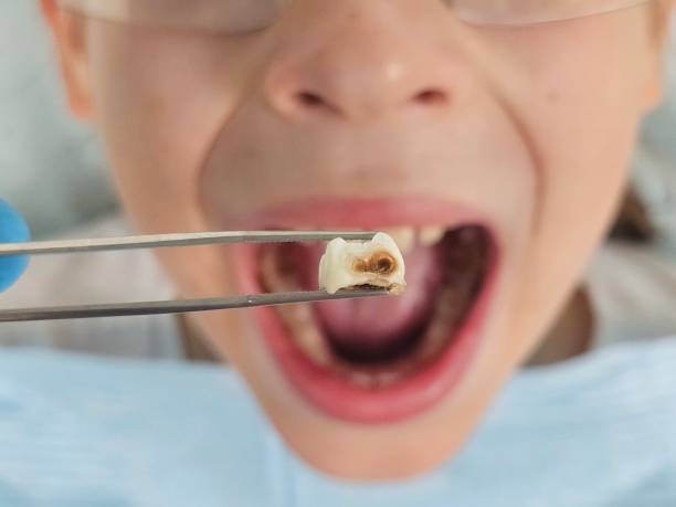 Best Emergency Wisdom Teeth Removal in Elton, LA